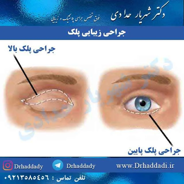 جراحی زیبایی پلک