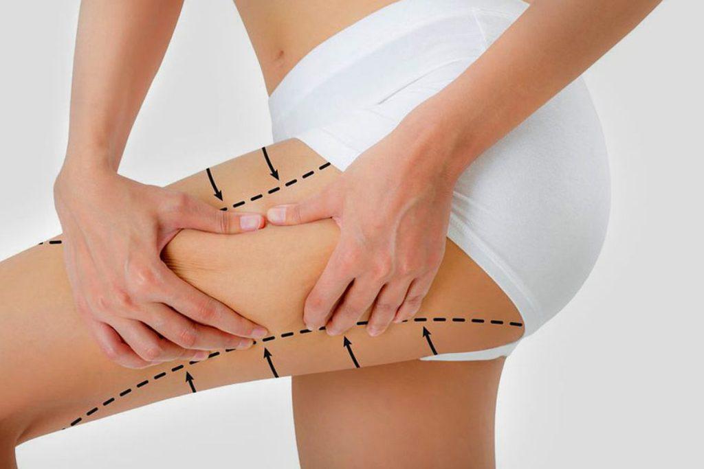 Side effects of thigh fat removal