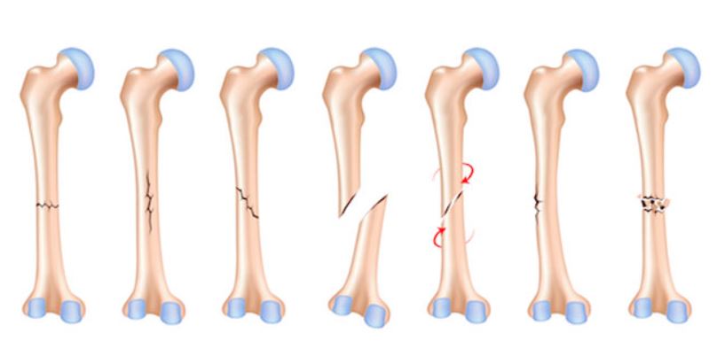 شکستگی استخوان چقدر طول میکشد؟