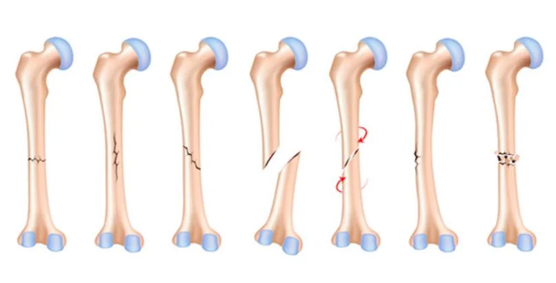 شکستگی استخوان چقدر طول میکشد؟